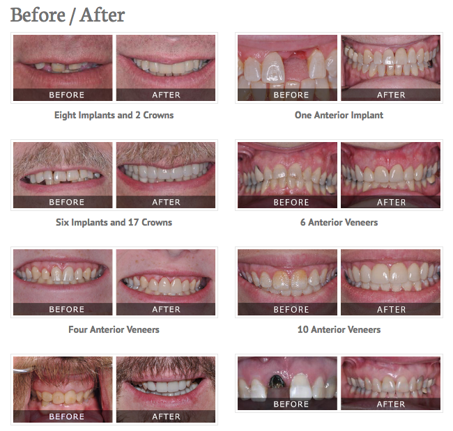 use before and after photo's to advertise your dental services