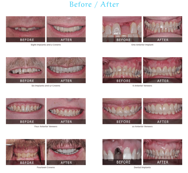 Dental website design: Use before and after photo's to advertise your dental services