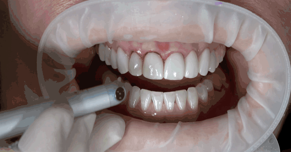 Usage of Laser Technology in Dentistry: Dental Trend